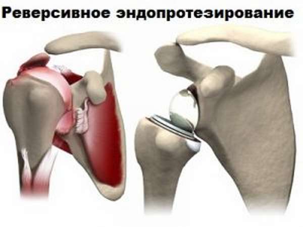 Операция по замене плечевого сустава